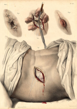 2 Antique Medical Anatomy Prints-ARTIFICIAL ANUS-LEFT LUMBAR-Pl 42-Bourgery-1831