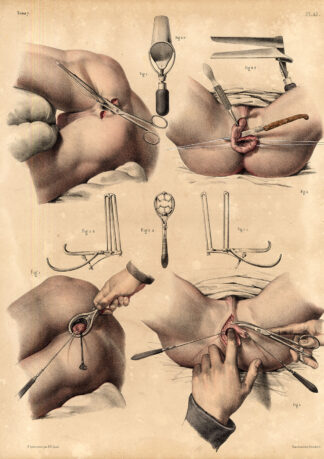2 Antique Medical Anatomy Prints-RECTUM-OPERATION-SURGERY-Pl. 45-Bourgery-1831