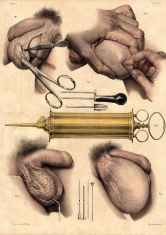 2 Antique Medical Anatomy Prints-TESTICLES-HYDROCELE-SARCOCELE-P48-Bourgery-1831