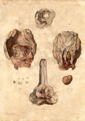 Antique Medical Anatomy Print-URINARY BLADDER-PROSTATE-CALCULI-P55-Bourgery-1831