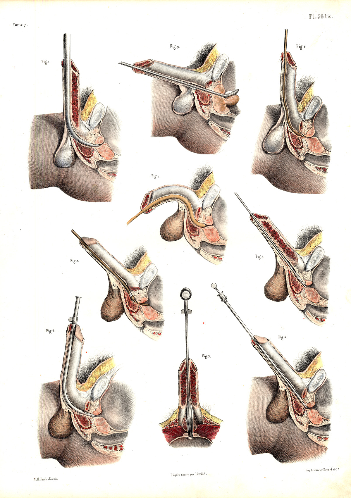 , 2 Antique Medical Anatomy Prints-URETHRA-PENIS-SURGERY-Pl. 56-Bourgery-1831, Pictura Antique Prints