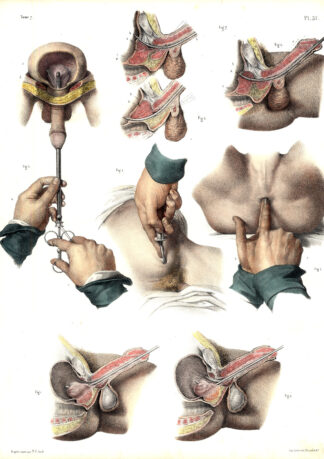 2 Antique Medical Anatomy Prints-URETHRA-PROSTATE-BLADDER-Pl. 57-Bourgery-1831