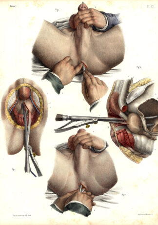 3 Antique Medical Anatomy Prints-LITHOTOMY-GENITALS-CALCULI-Pl. 62-Bourgery-1831
