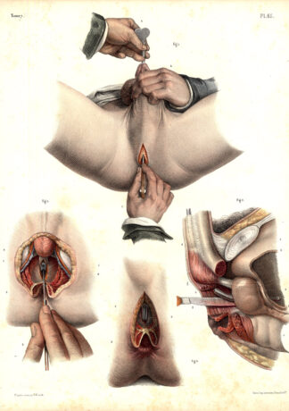 3 Antique Medical Anatomy Prints-LITHOTOMY-GENITALS-CALCULI-Pl. 65-Bourgery-1831