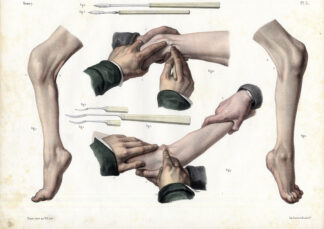 2 Antique Medical Anatomy Prints-TENOTOMY-SURGICAL INSTRUMENTS-P L-Bourgery-1831