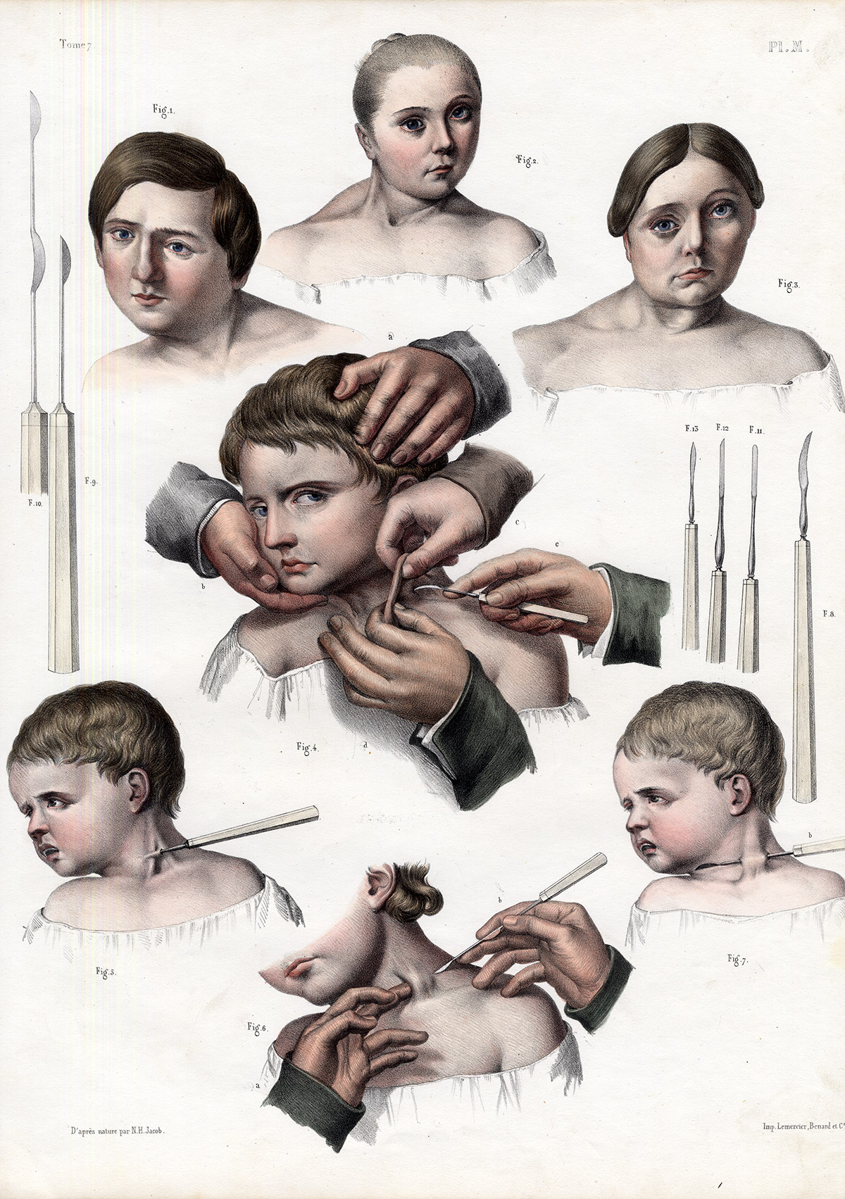 , 2 Antique Medical Anatomy Prints-TENOTOMY-SURGICAL INSTRUMENTS-P L-Bourgery-1831, Pictura Antique Prints