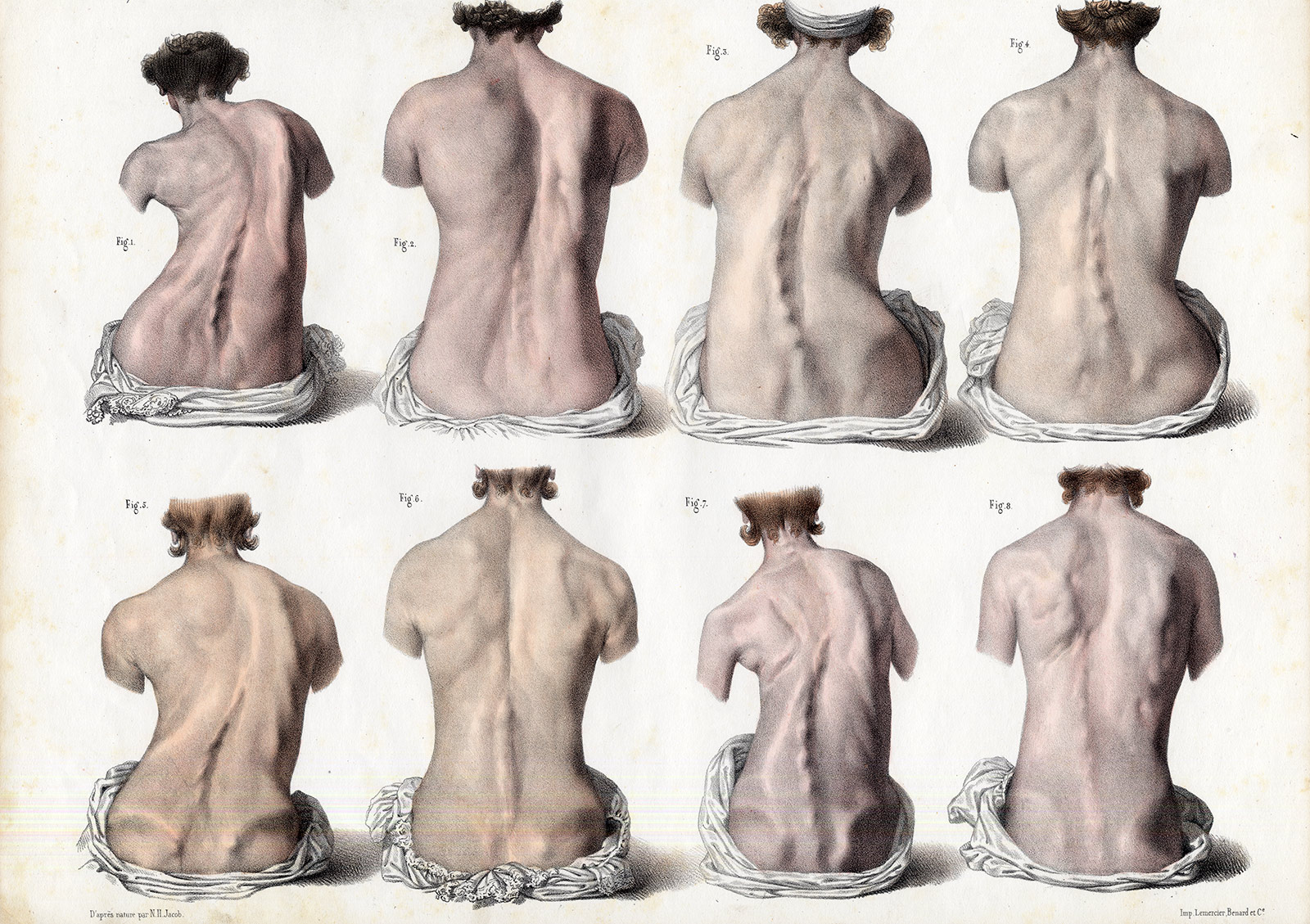 , 2 Antique Medical Prints-ERECTOR SPINAE MUSCLES-RETRACTION-Pl. O-Bourgery-1831, Pictura Antique Prints