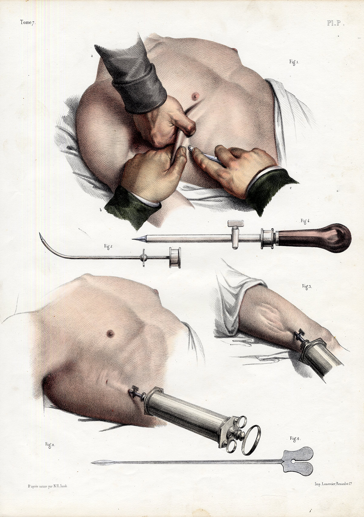 , 2 Antique Medical Prints-ERECTOR SPINAE MUSCLES-RETRACTION-Pl. O-Bourgery-1831, Pictura Antique Prints
