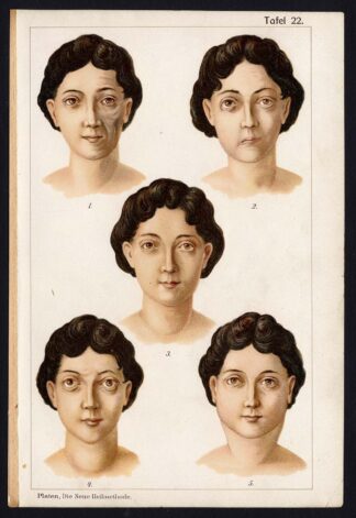 Antique Print-MEDICAL-ATROPHY-STROKE-GRAVES' DISEASE-PAROTIS-Taf 22-Platen-1907
