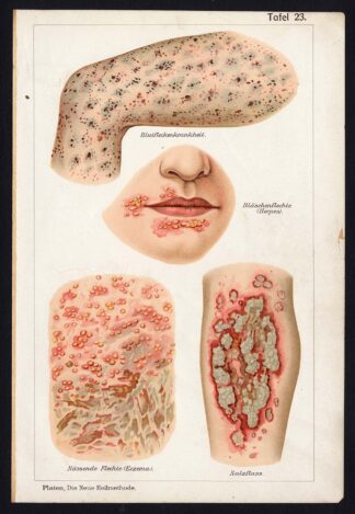 Antique Print-MEDICAL-HERPES-ECZEMA-Taf 23-Platen-1907