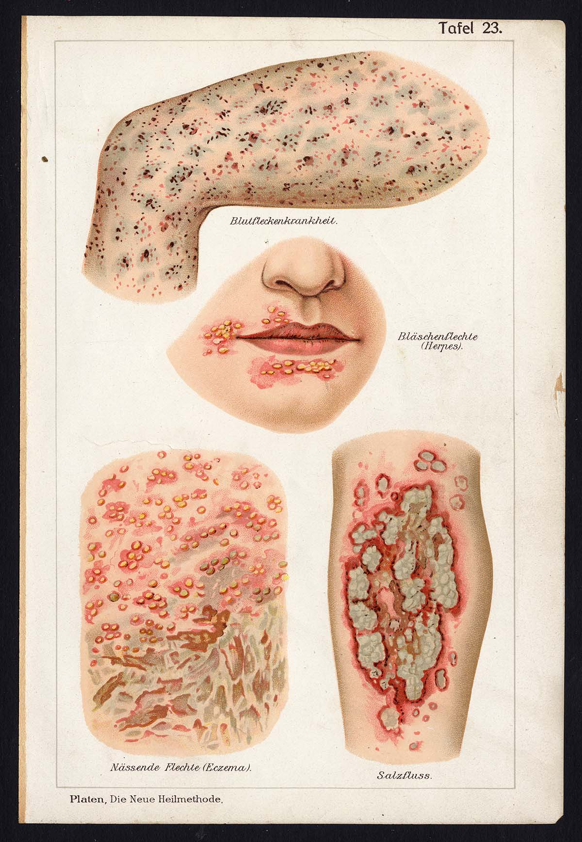 , Antique Print-MEDICAL-HERPES-ECZEMA-Taf 23-Platen-1907, Pictura Antique Prints