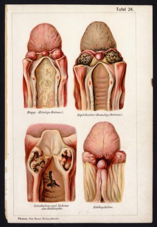 Antique Print-MEDICAL-THROAT-DIPHTHERIA-TUBERCULOSIS-DISEASES-Taf 24-Platen-1907