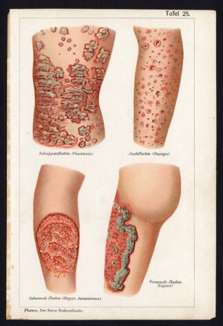 Antique Print-MEDICAL-PSORIASIS-PRURIGO-HERPES-LUPUS-DISEASES-Taf 25-Platen-1907