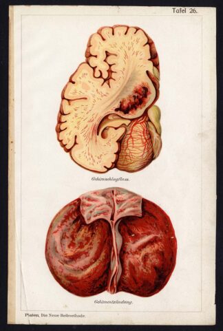 Antique Print-MEDICAL-STROKE-ENCEPHALITIS-BRAIN-DISEASES-Taf 26-Platen-1907