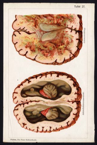 Antique Print-MEDICAL-PARESIS-HYDROPS COCHLEAE-BRAIN-DISEASES-Taf 27-Platen-1907
