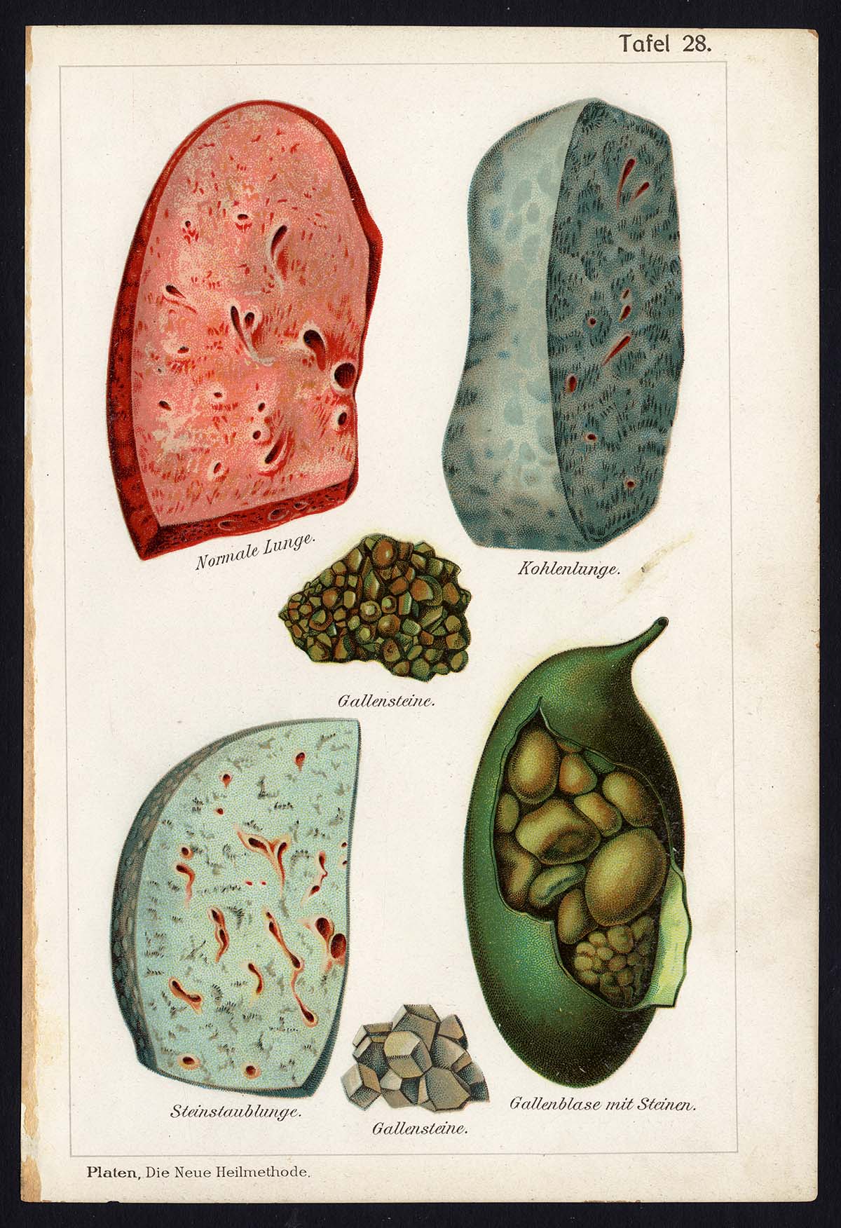 , Antique Print-MEDICAL-STONECOALLUNG, GALL-STONES, DUSTLUNGS-Taf 28-Platen-1907, Pictura Antique Prints