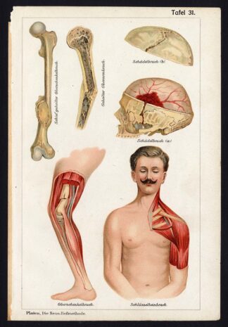 Antique Print-MEDICAL-FRACTURE-FEMUR-ARM-SKULL-CLAVICLE-Taf 31-Platen-1907