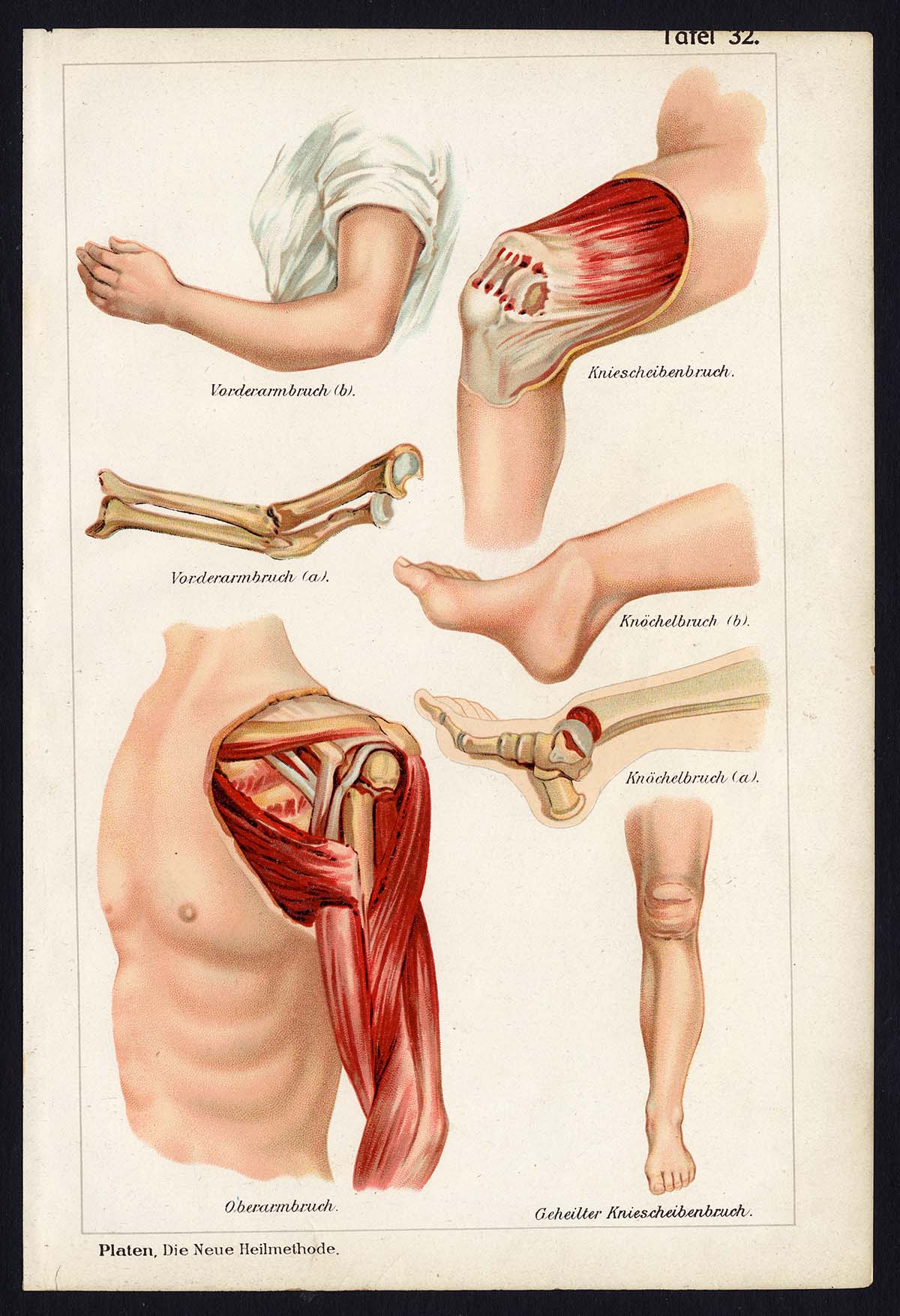 , Antique Print-MEDICAL-FRACTURE- FOREARM-ARM-KNEE CAP-JUST-Taf 32-Platen-1907, Pictura Antique Prints