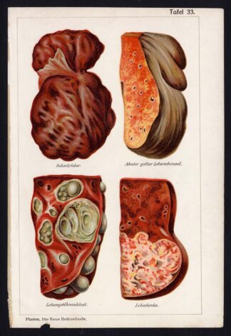 Antique Print-MEDICAL-LIVER-ATROPHY-CORD-CANCER-DISEASES-Taf 33-Platen-1907