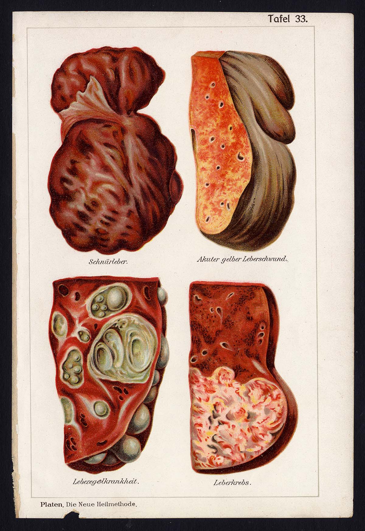 , Antique Print-MEDICAL-LIVER-ATROPHY-CORD-CANCER-DISEASES-Taf 33-Platen-1907, Pictura Antique Prints
