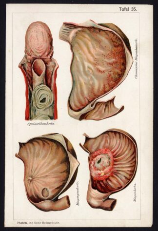 Antique Print-MEDICAL-ESOPHAGUS-STOMACH-INFLAMMATION-ULCER-Taf 35-Platen-1907