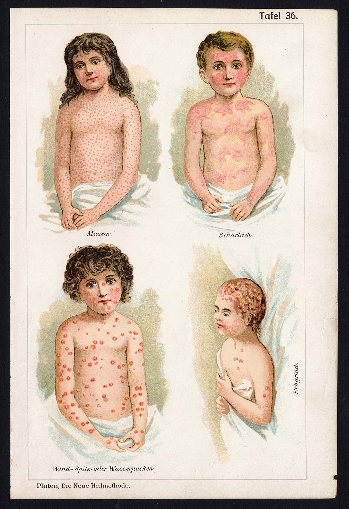 , Antique Print-MEDICAL-MEASLES-CHICKENPOX-SCARLET FEVER-DISEAE-Taf 36-Platen-1907, Pictura Antique Prints