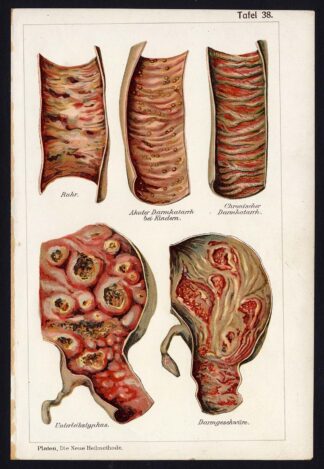 Antique Print-MEDICAL-DYSENTERY-COLIC-TYPHUS-ULCUS-DISEAES-Taf 38-Platen-1907
