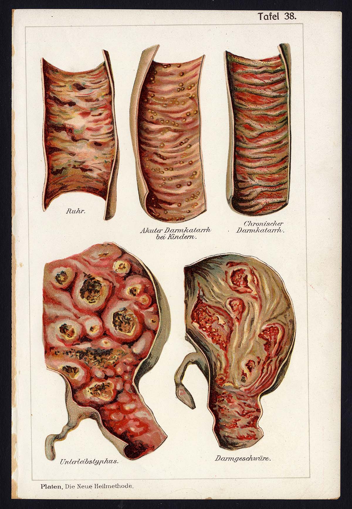 , Antique Print-MEDICAL-DYSENTERY-COLIC-TYPHUS-ULCUS-DISEAES-Taf 38-Platen-1907, Pictura Antique Prints