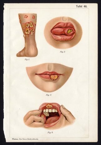 Antique Print MEDICAL-SYPHILIS-LEG-TONGUE-LIP-CHEEK-DISEASES-Taf 48-Platen-1907