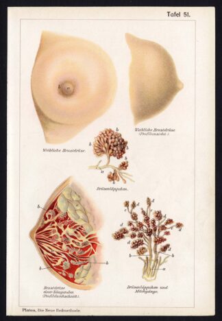 Antique Print MEDICAL-BREAST-MAMMARY-GLAND-DISEAES-Taf 51-Platen-1907