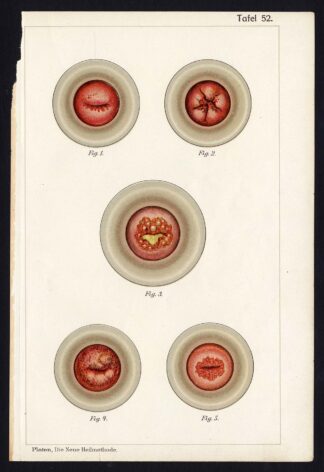 Antique Print MEDICAL-INFLAMMATION-UTERUS-CERVIX-DISEAES-Taf 52-Platen-1907