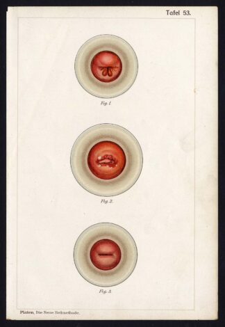 Antique Print MEDICAL-UTERUS-POLYPS-FIBROID-CERVIX-DISEAES-Taf 53-Platen-1907