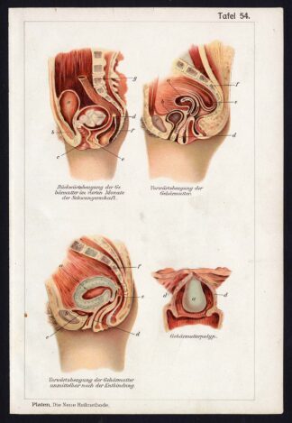 Antique Print MEDICAL-UTERUS-POLYPS-FIBROID-CERVIX-DISEAES-Taf 54-Platen-1907