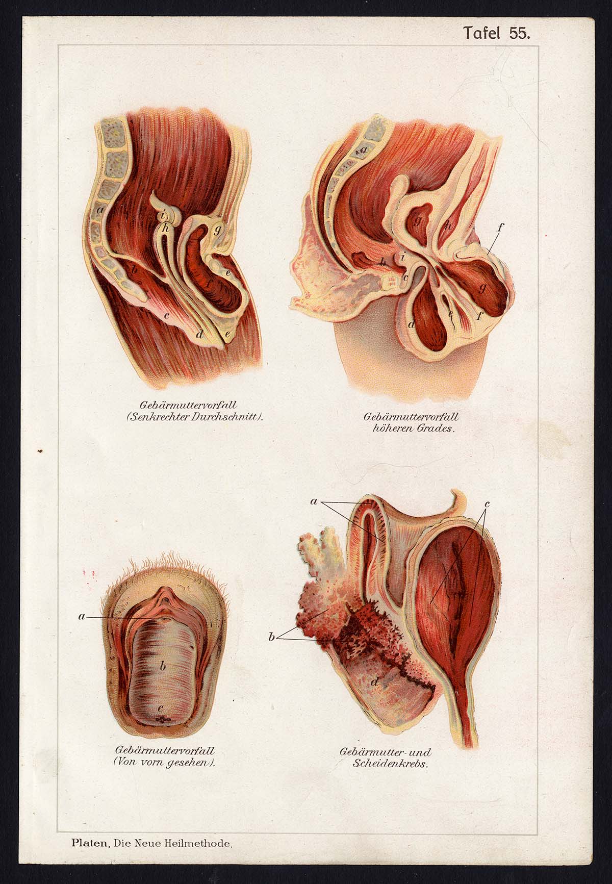 , Antique Print MEDICAL-UTERUS-PROLAPS-CANCER-DISEAES-Taf 55-Platen-1907, Pictura Antique Prints
