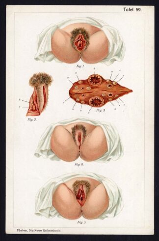 Antique Print MEDICAL-GENITALS-OVARY-BARTHOLIN-GLAND-DISEAES-Taf 59-Platen-1907
