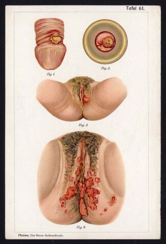 Antique Print MEDICAL-UTERUS--DISEAES-Taf 62-Platen-1907