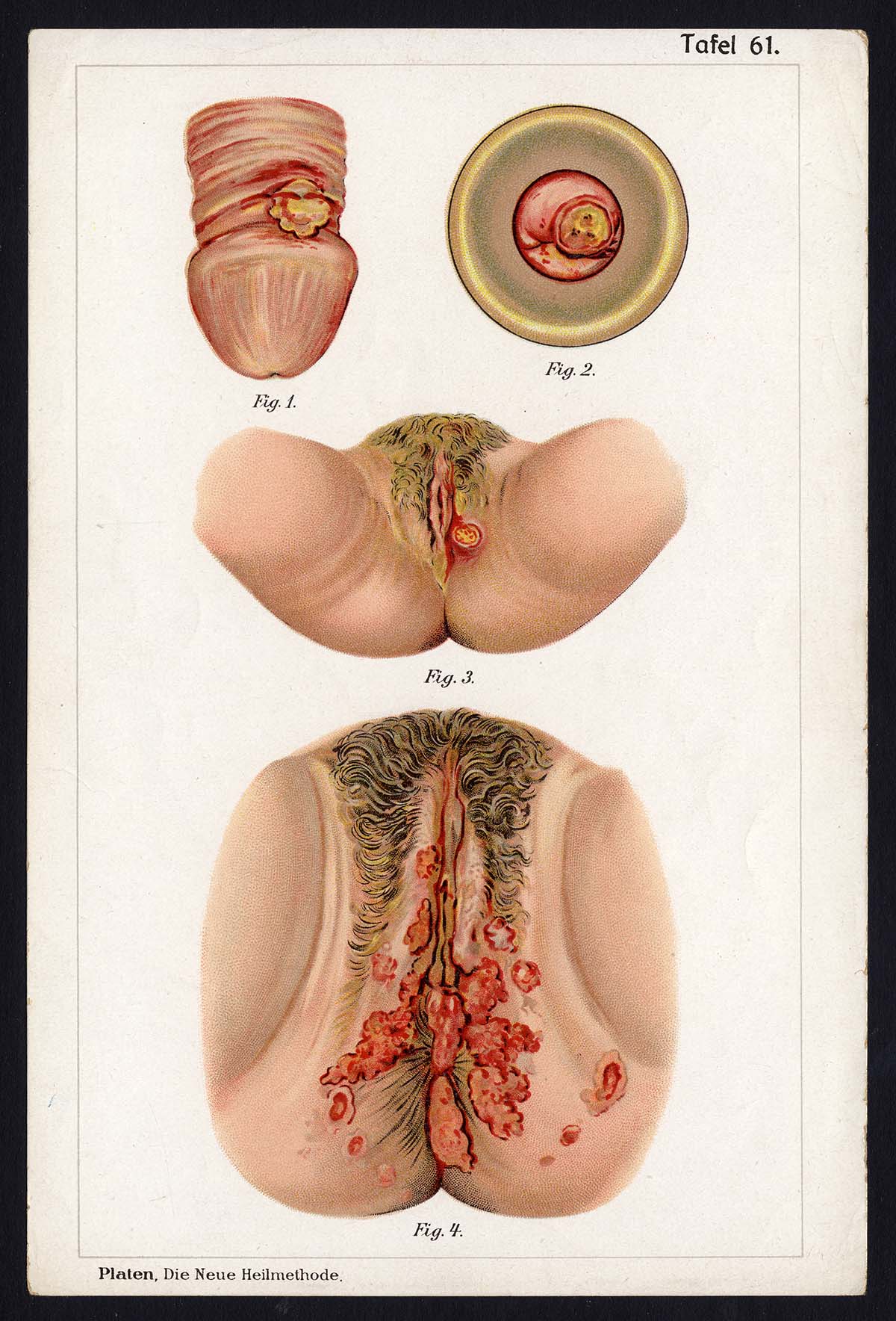 , Antique Print MEDICAL-UTERUS–DISEAES-Taf 62-Platen-1907, Pictura Antique Prints