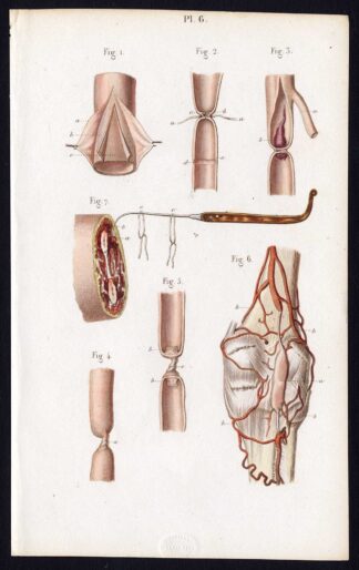 Antique Print-SURGERY-LIGATURE OF ARTERIES-BLOOD-OPERATION-Bernard-Davesne-1846