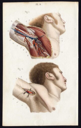 Antique Print-SURGERY-LIGATURE OF ARTERIES-AXILLARY-ARMPITS-Bernard-Davesne-1846