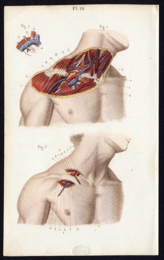 Antique Print-SURGERY-LIGATURE OF ARTERIES-SUBCLAVIAN-VEINS-Bernard-Davesne-1846