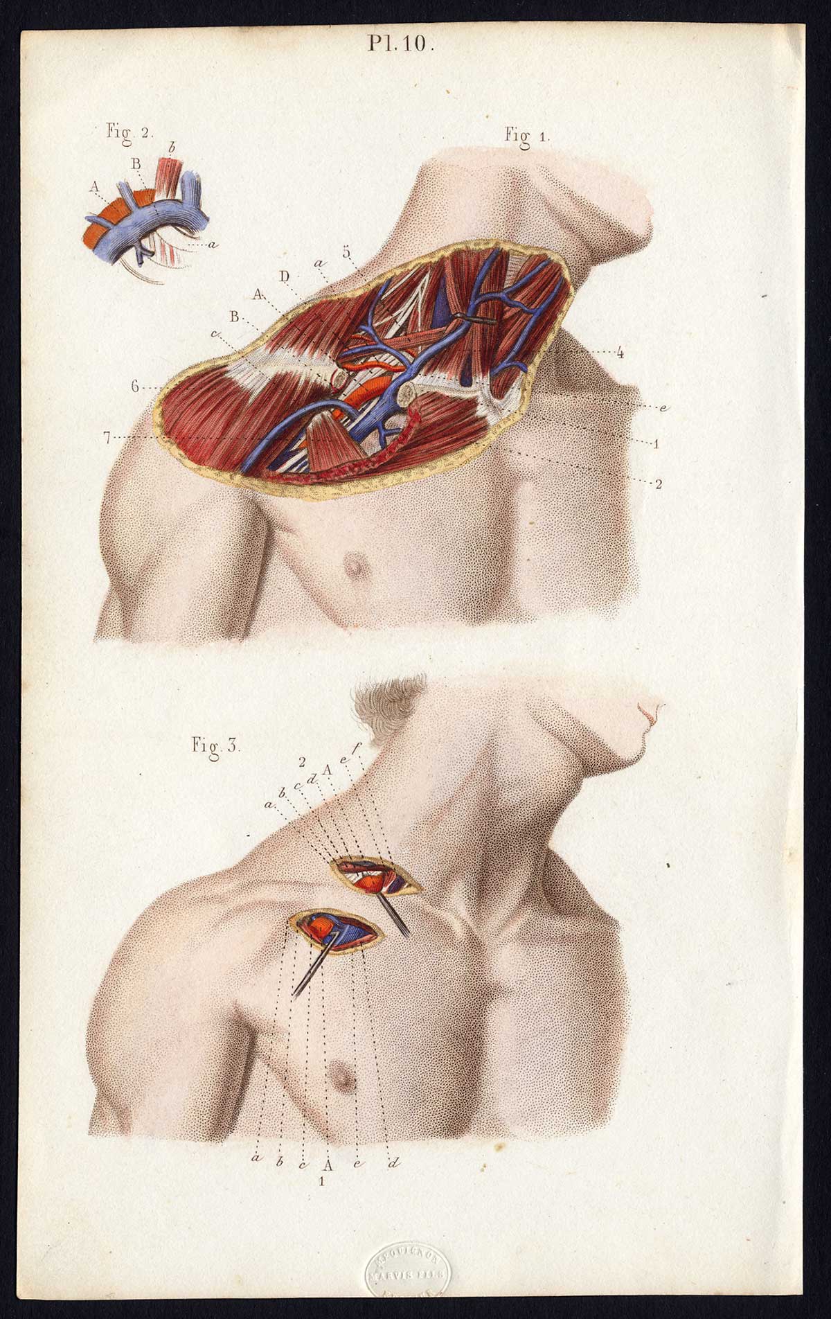 , Antique Print-SURGERY-LIGATURE OF ARTERIES-SUBCLAVIAN-VEINS-Bernard-Davesne-1846, Pictura Antique Prints