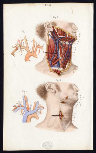 Antique Print-SURGERY-LIGATURE-ARTERIES-PRIMITIVE CAROTID-Bernard-Davesne-1846