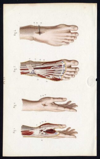 Antique Print-SURGERY-LIGATURE OF ARTERIES-RADIAL-PEDAL-Bernard-Davesne-1846