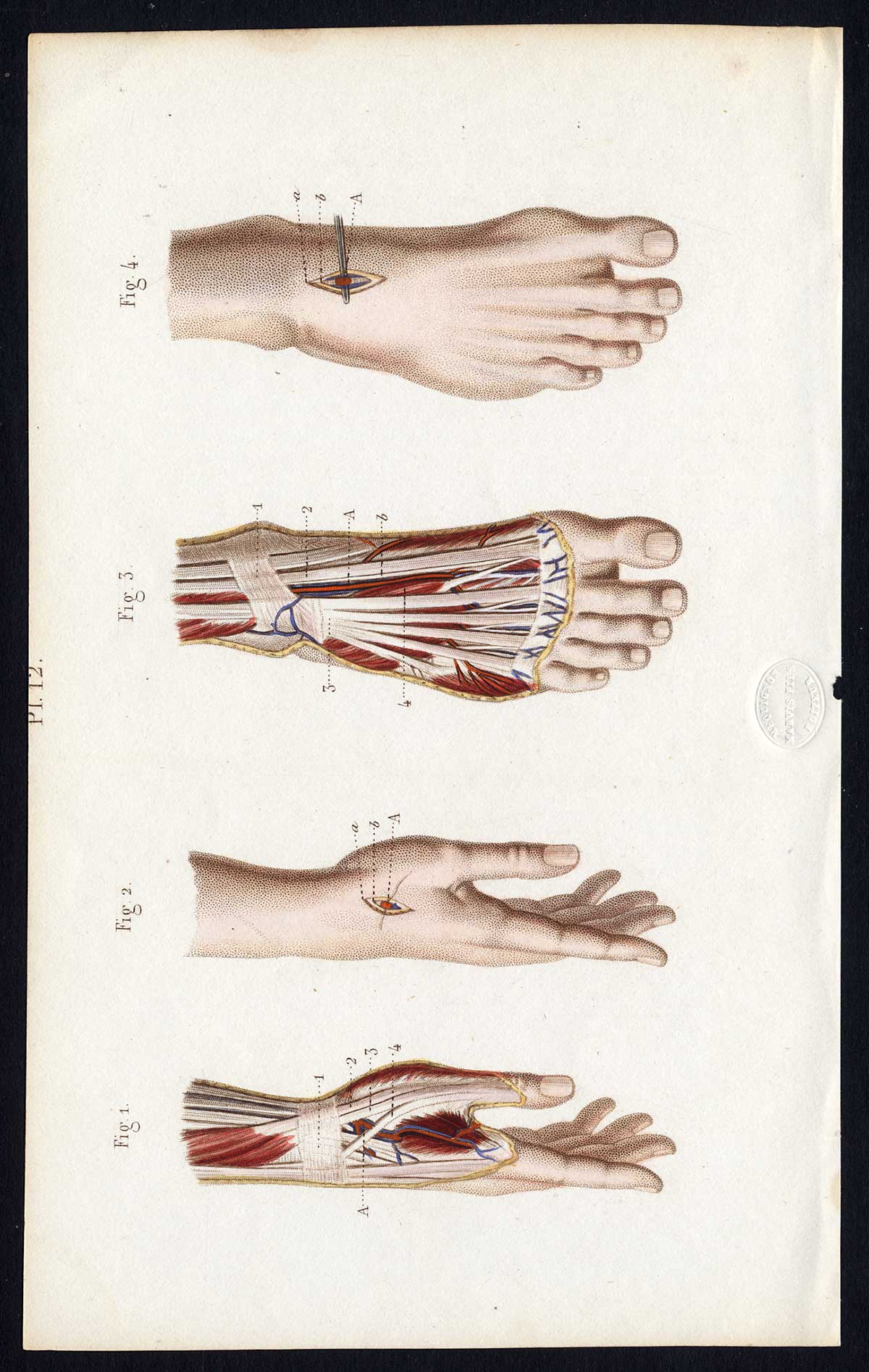, Antique Print-SURGERY-LIGATURE OF ARTERIES-RADIAL-PEDAL-Bernard-Davesne-1846, Pictura Antique Prints