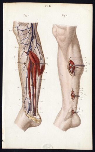 Antique Print-SURGERY-LIGATURE OF ARTERIES-POSTERIOR TIBIAL-Bernard-Davesne-1846