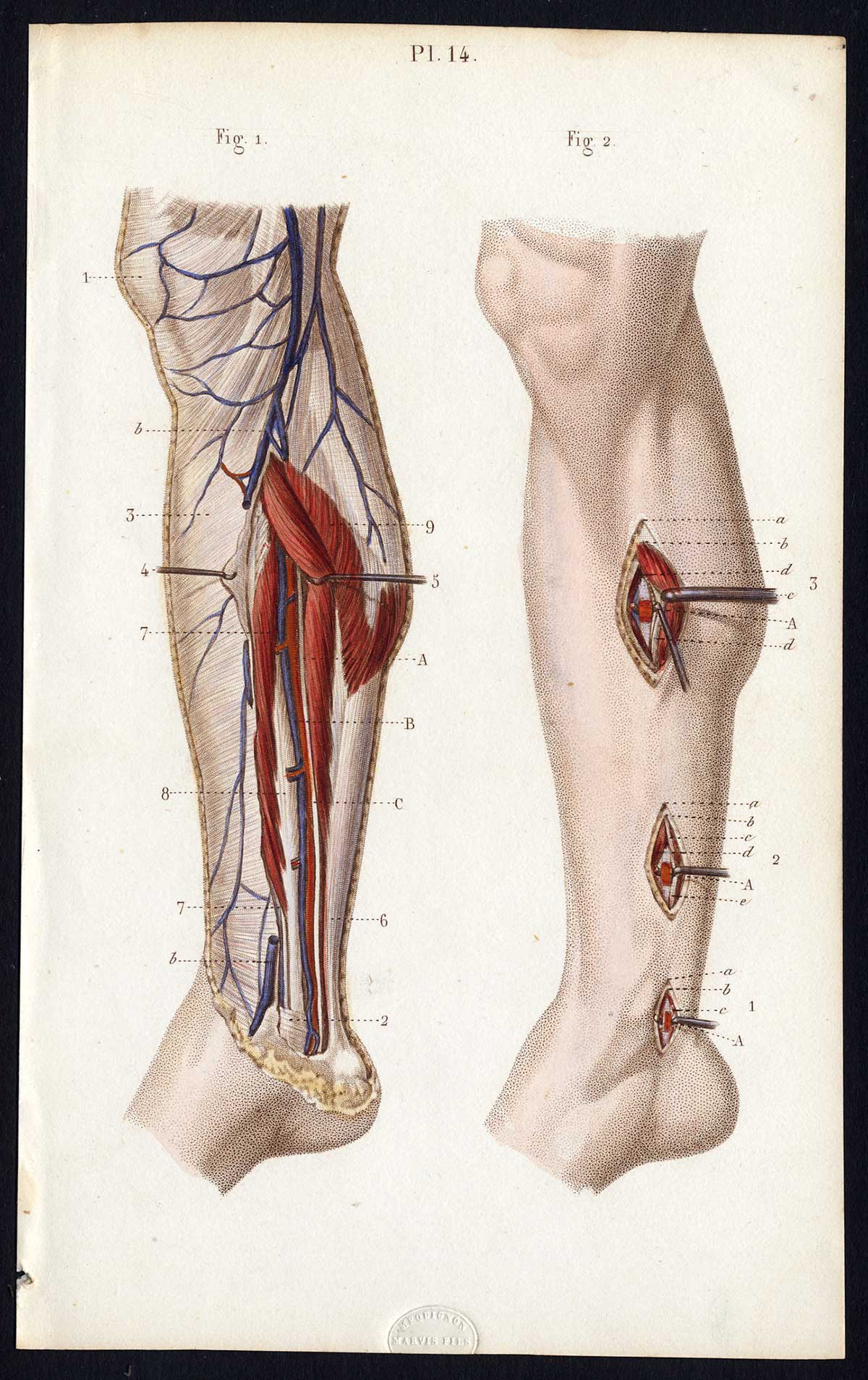 , Antique Print-SURGERY-LIGATURE OF ARTERIES-POSTERIOR TIBIAL-Bernard-Davesne-1846, Pictura Antique Prints
