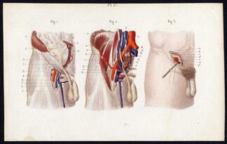 Antique Print-SURGERY-LIGATURE-ARTERY-GENITALS-EPIGASTRIUM-Bernard-Davesne-1846