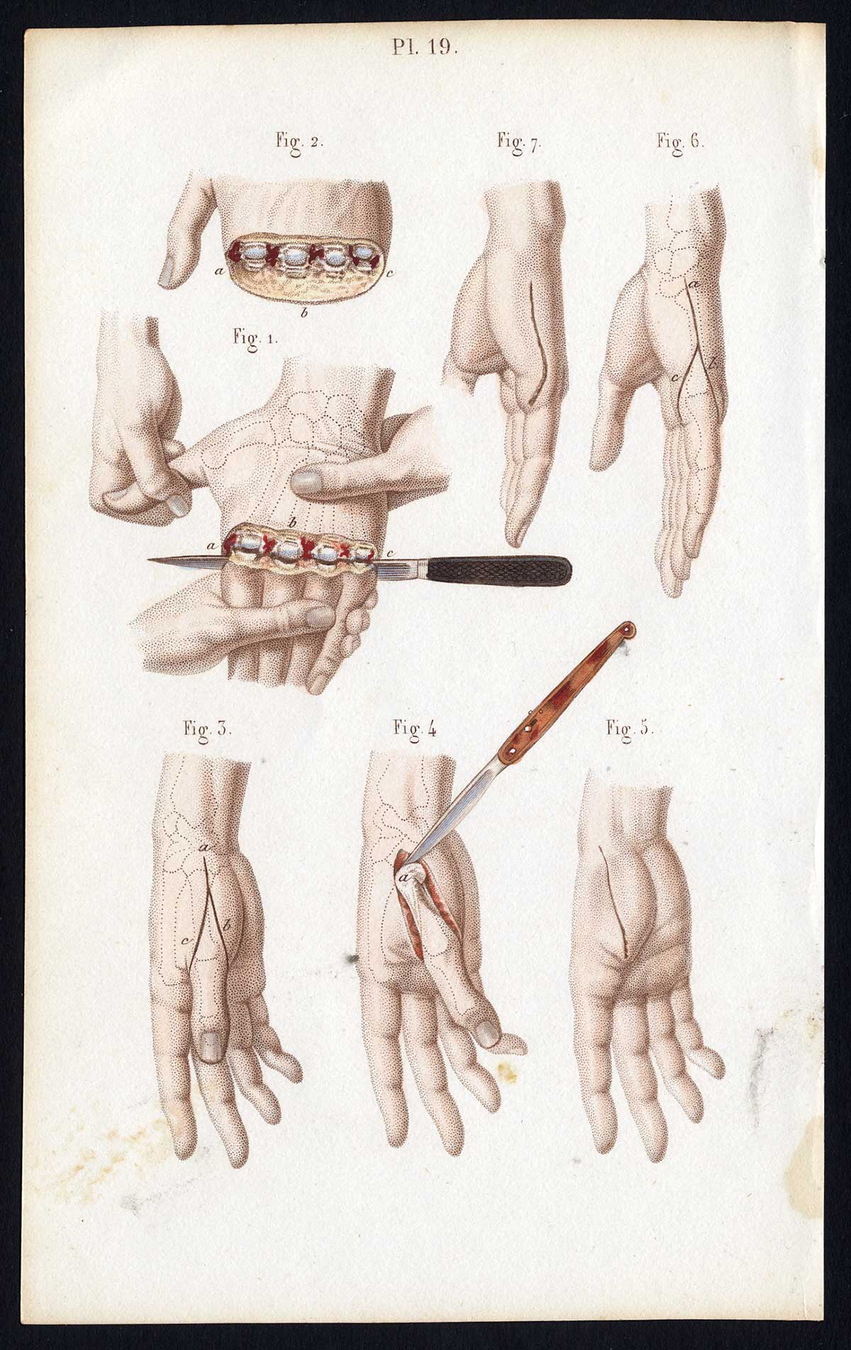 , Antique Print-SURGERY-DISARTICULATION-FINGER-METACARPUS-Bernard-Davesne-1846, Pictura Antique Prints