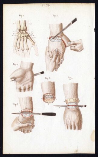 Antique Print-SURGERY-DISARTICULATION-HAND-WRIST-JOINT-Bernard-Davesne-1846