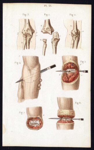 Antique Print-SURGERY-DISARTICULATION-ELBOW-JOINT-Bernard-Davesne-1846